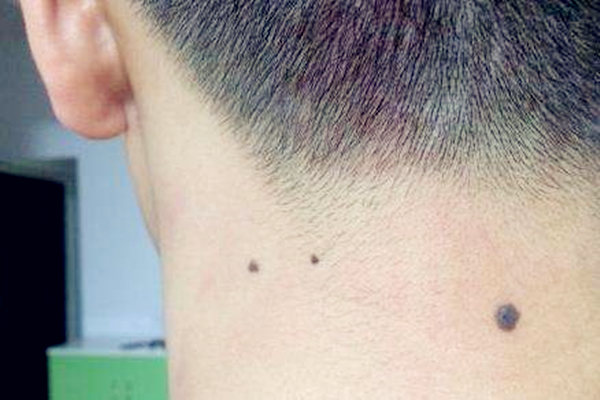 脖子后有痣代表什么