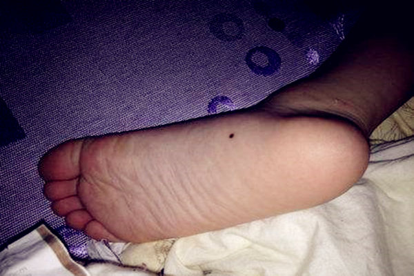 男人脚底痣好吗