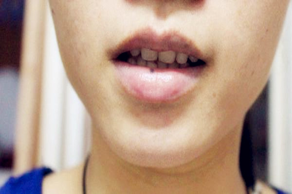 嘴唇上有痣好吗 嘴唇上有痣好吗