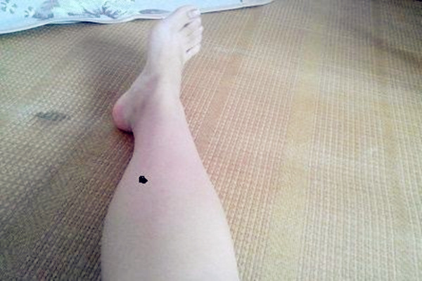 大腿上长痣好吗