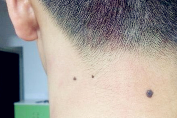 脖子上长痣面相好吗