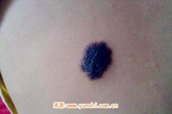 身上长胎记代表什么 身上长胎记代表什么