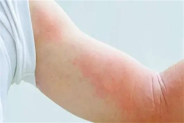 什么样的八字容易得皮肤病